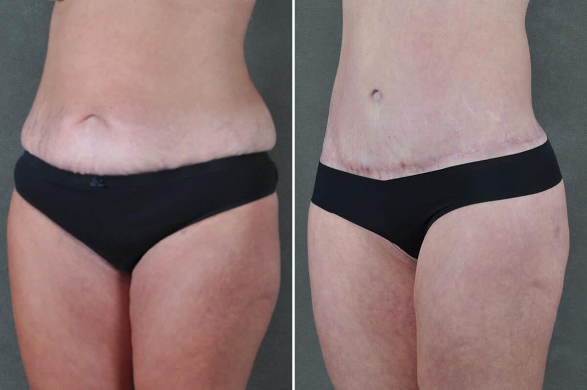 Liposuction Before and After Photos in Omaha, NE, Case 19401