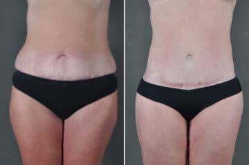 Liposuction Before and After Photos in Omaha, NE, Case 19401