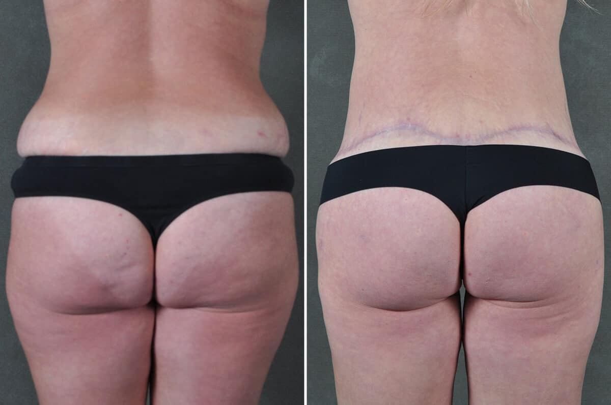 Liposuction Before and After Photos in Omaha, NE, Case 19401