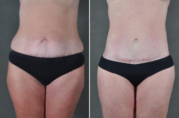 Liposuction Before and After Photos in Omaha, NE, Case 19401