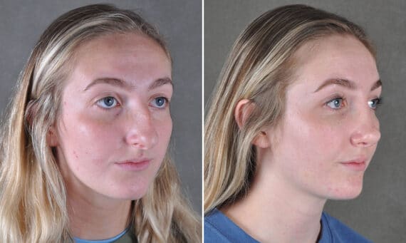 Rhinoplasty Before and After Photos in Omaha, NE, Case 19431