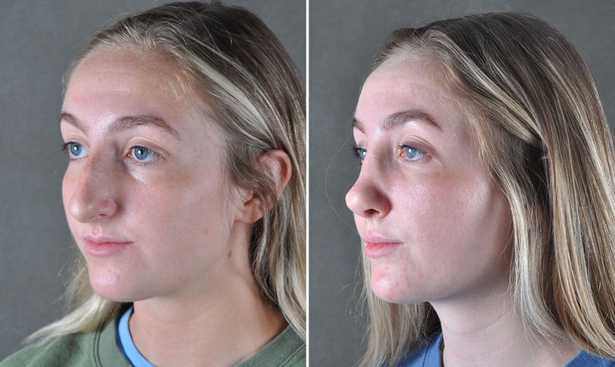 Rhinoplasty Before and After Photos in Omaha, NE, Case 19431