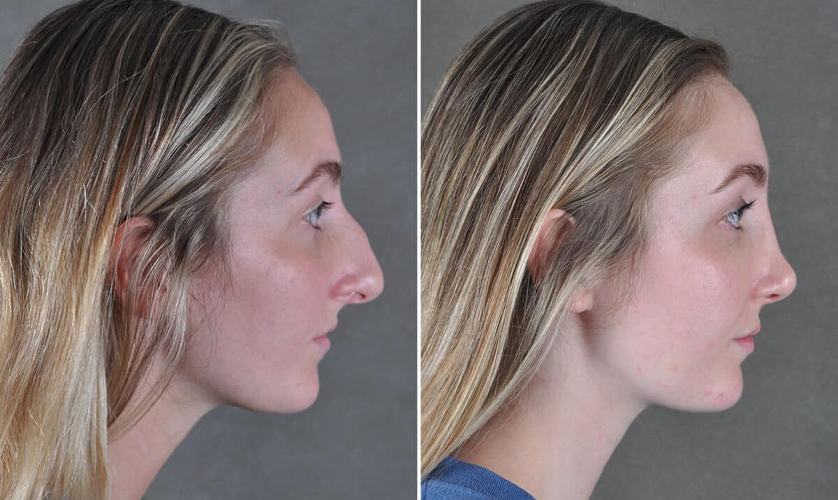 Rhinoplasty Before and After Photos in Omaha, NE, Case 19431