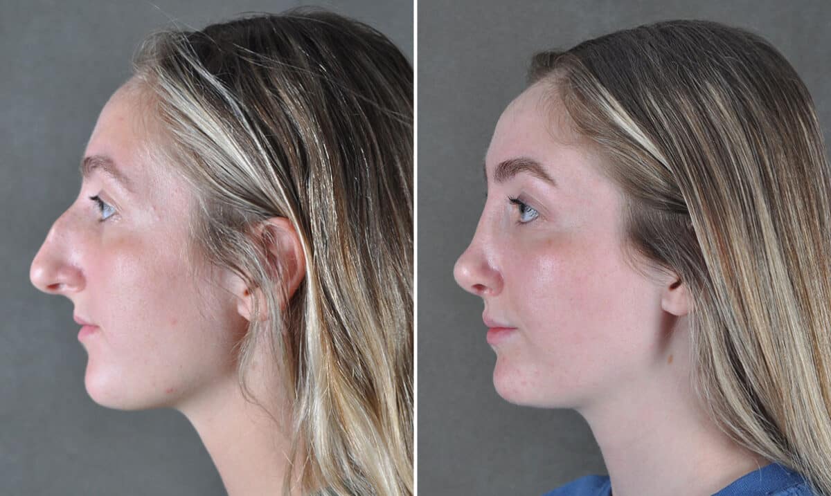 Rhinoplasty Before and After Photos in Omaha, NE, Case 19431