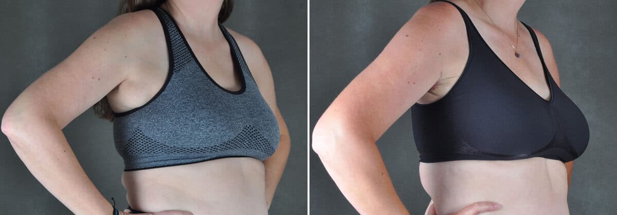 Excision Bilateral Axillary Tissue Before and After Photos in Omaha, NE, Case 19448