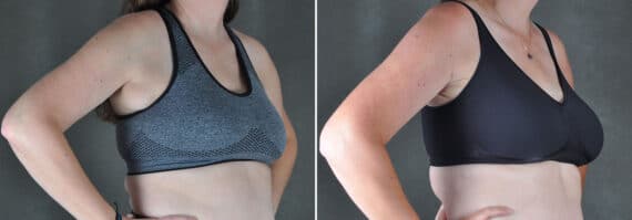 Excision Bilateral Axillary Tissue Before and After Photos in Omaha, NE, Case 19448