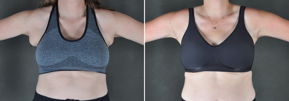 Excision Bilateral Axillary Tissue Before and After Photos in Omaha, NE, Case 19448