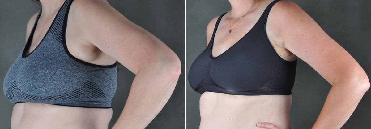 Excision Bilateral Axillary Tissue Before and After Photos in Omaha, NE, Case 19448