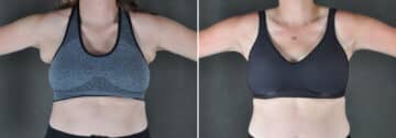 Excision Bilateral Axillary Tissue Before and After Photos in Omaha, NE, Case 19448