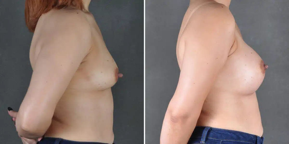 Case 19458, Breast Augmentation Before and After Photos Breast Augmentation Before and After Photos in Omaha, NE, Case 19458