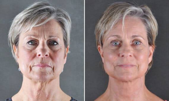 Blepharoplasty Before and After Photos in Omaha, NE, Case 19474