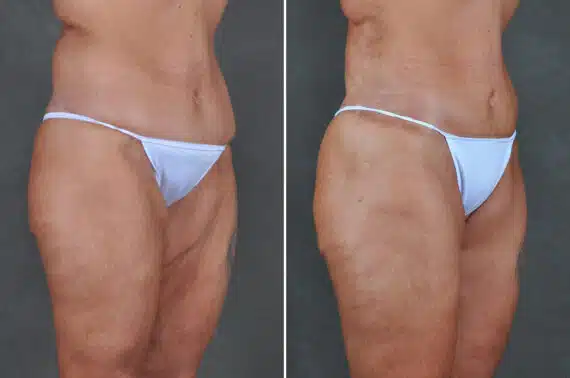 Liposuction Before and After Photos in Omaha, NE, Case 19505