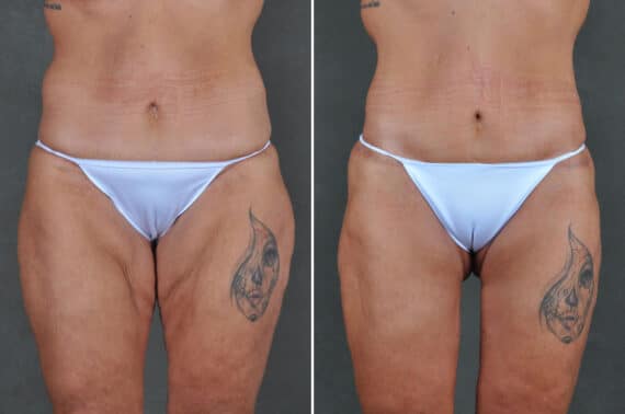 Liposuction Before and After Photos in Omaha, NE, Case 19505