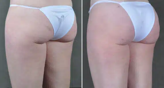 Brazilian Butt Lift Before and After Photos in Omaha, NE, Case 19542