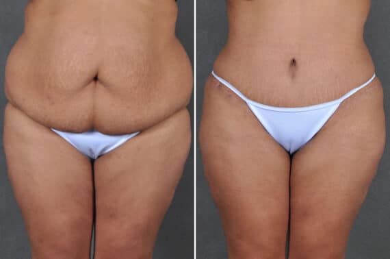 Liposuction Before and After Photos in Omaha, NE, Case 19621