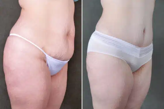 Liposuction Before and After Photos in Omaha, NE, Case 19640