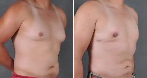 Gynecomastia Before and After Photos in Omaha, NE, Case 19674