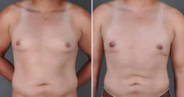 Gynecomastia Before and After Photos in Omaha, NE, Case 19674