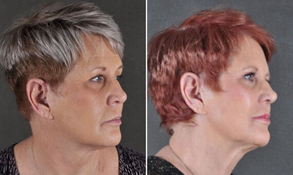 Blepharoplasty Before and After Photos in Omaha, NE, Case 19690