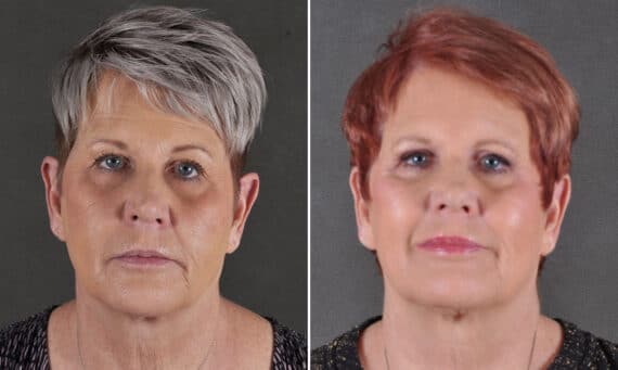 Blepharoplasty Before and After Photos in Omaha, NE, Case 19690