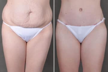 Liposuction Before and After Photos in Omaha, NE, Case 19706
