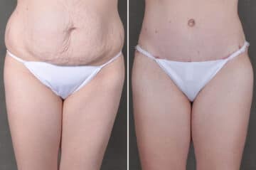 Liposuction Before and After Photos in Omaha, NE, Case 19706