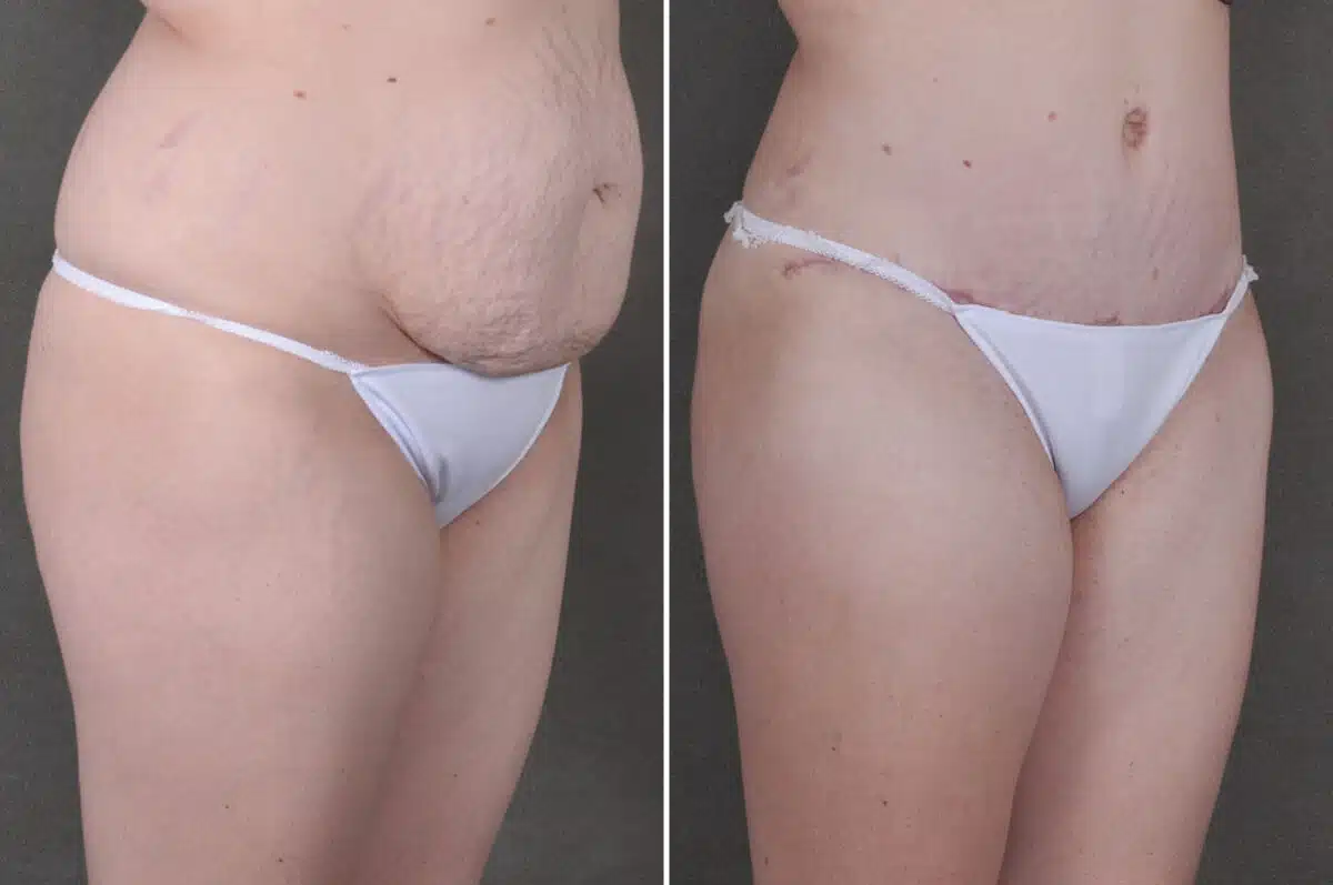 Liposuction Before and After Photos in Omaha, NE, Case 19706