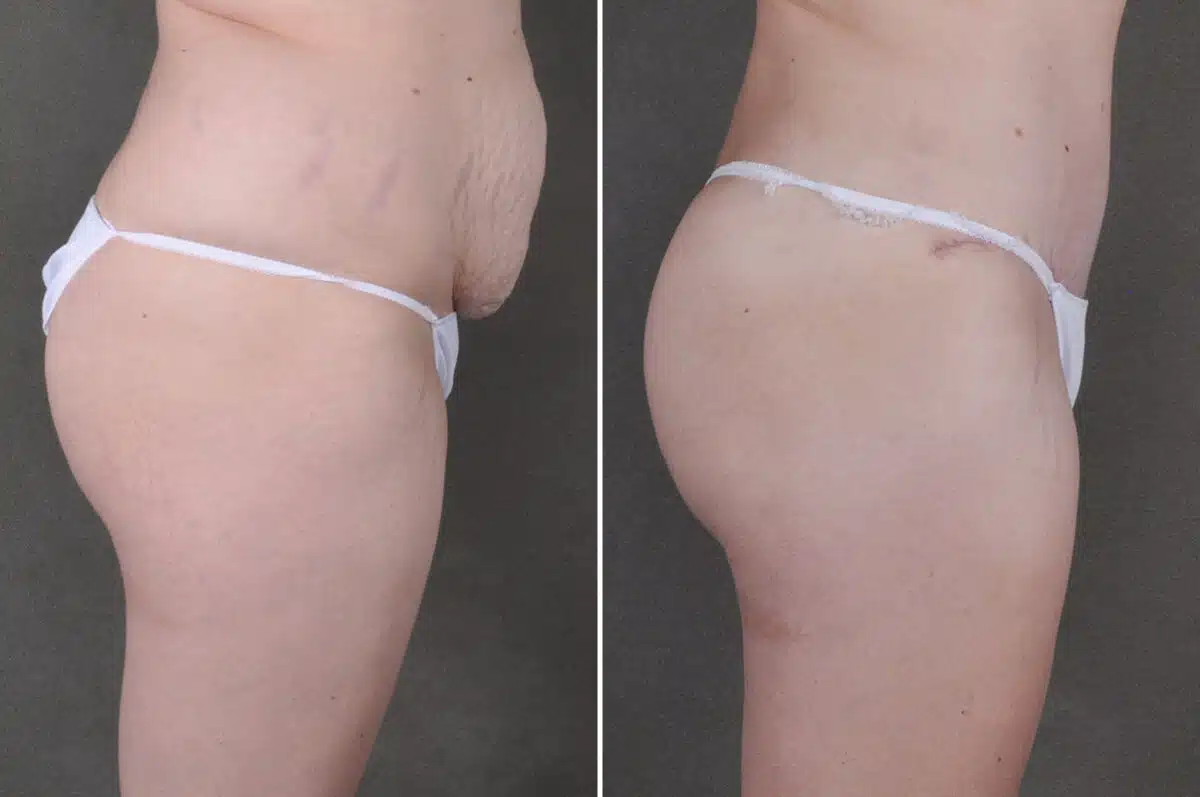 Liposuction Before and After Photos in Omaha, NE, Case 19706