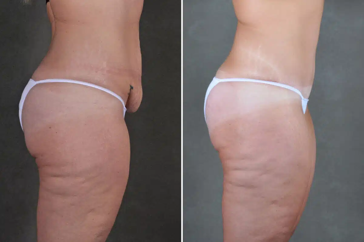 Liposuction Before and After Photos in Omaha, NE, Case 19865