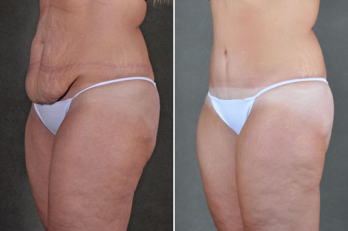 Liposuction Before and After Photos in Omaha, NE, Case 19865