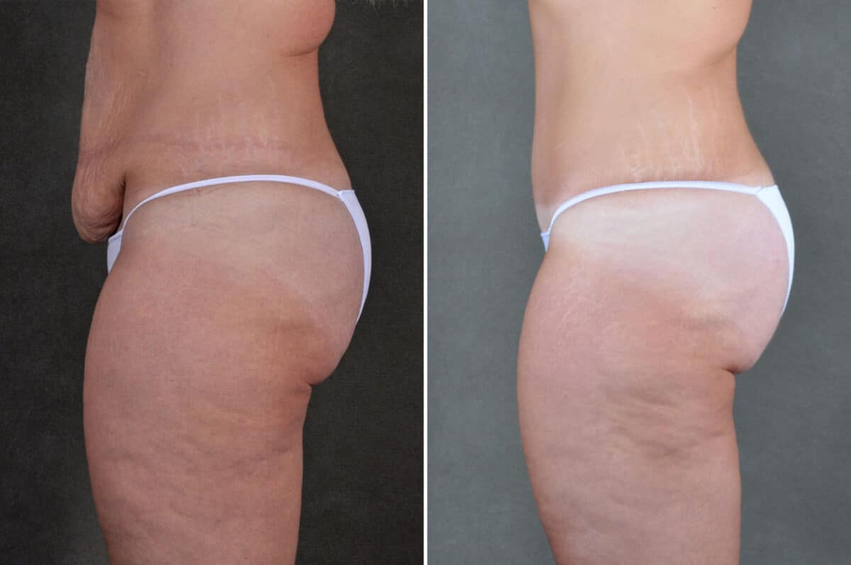 Liposuction Before and After Photos in Omaha, NE, Case 19865