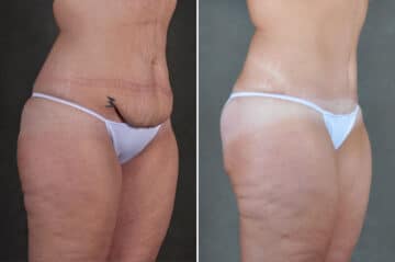 Liposuction Before and After Photos in Omaha, NE, Case 19865