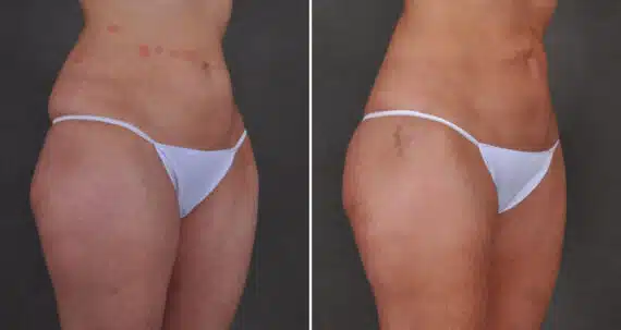 Liposuction Before and After Photos in Omaha, NE, Case 19879