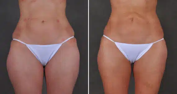 Liposuction Before and After Photos in Omaha, NE, Case 19879