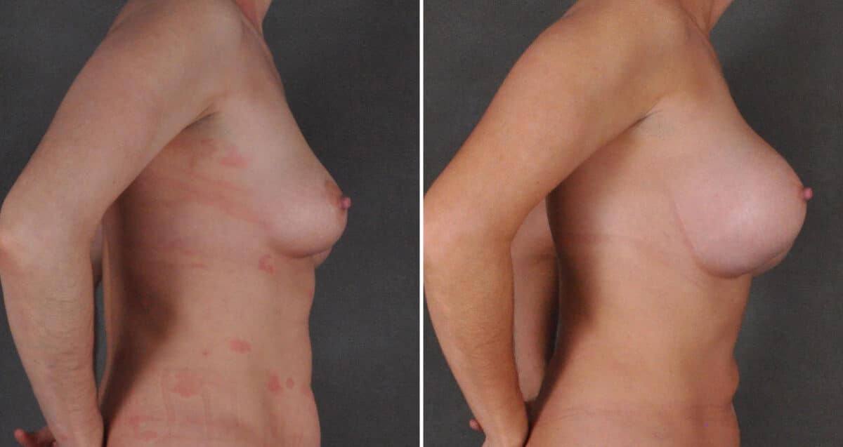 Case 19898, Breast Augmentation Before and After Photos Breast Augmentation Before and After Photos in Omaha, NE, Case 19898