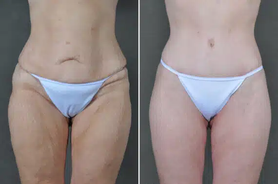 Liposuction Before and After Photos in Omaha, NE, Case 19908