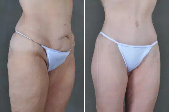 Liposuction Before and After Photos in Omaha, NE, Case 19908