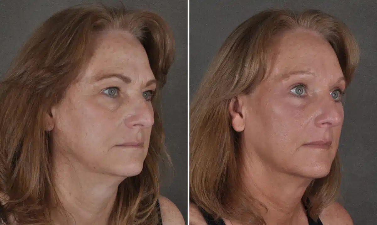 Blepharoplasty Before and After Photos in Omaha, NE, Case 19921