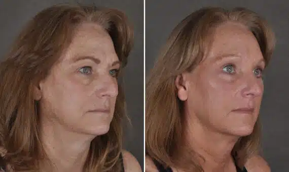 Blepharoplasty Before and After Photos in Omaha, NE, Case 19921