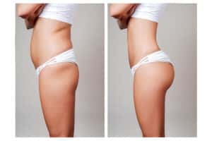 Before-and-after picture of a tummy tuck and buttock augmentation patient who underwent plastic surgery with an experienced cosmetic surgeon.