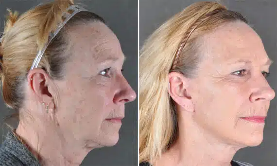 Blepharoplasty Before and After Photos in Omaha, NE, Case 21131