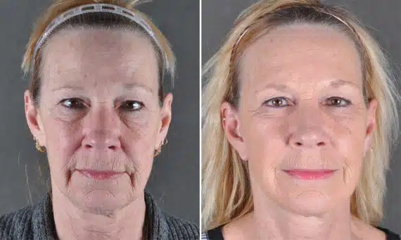Blepharoplasty Before and After Photos in Omaha, NE, Case 21131
