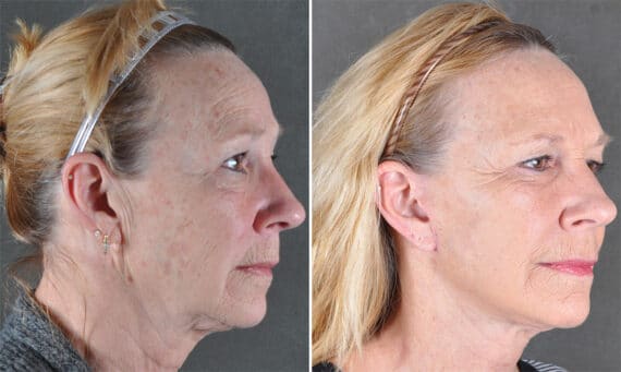 Facelift Before and After Photos in Omaha, NE, Case 21147