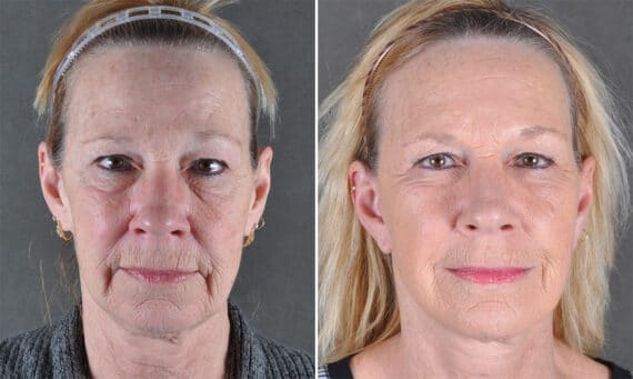 Facelift Before and After Photos in Omaha, NE, Case 21147