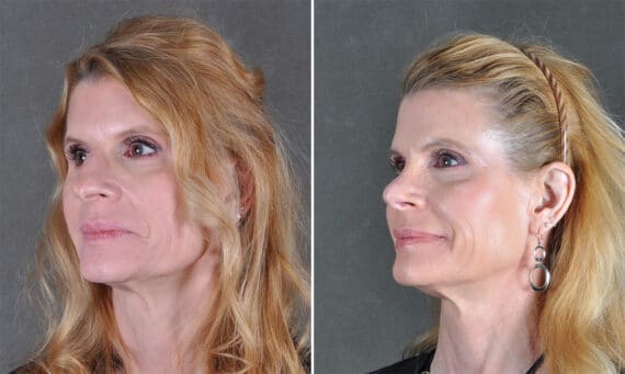 Rhinoplasty Before and After Photos in Omaha, NE, Case 21218