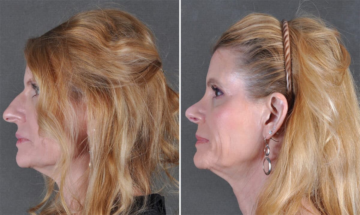 Rhinoplasty Before and After Photos in Omaha, NE, Case 21218
