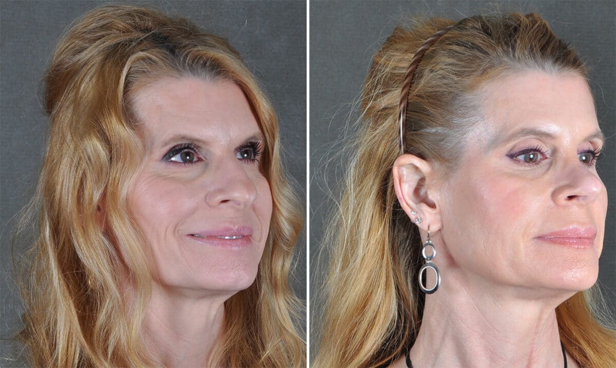 Rhinoplasty Before and After Photos in Omaha, NE, Case 21218