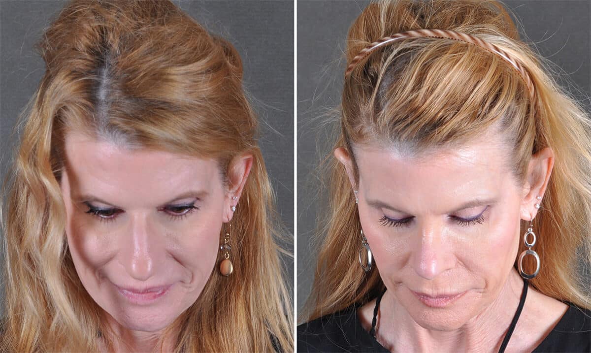 Rhinoplasty Before and After Photos in Omaha, NE, Case 21218