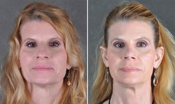 Rhinoplasty Before and After Photos in Omaha, NE, Case 21218
