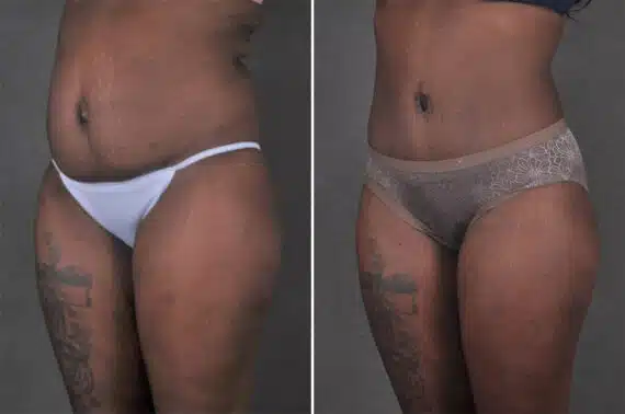 Liposuction Before and After Photos in Omaha, NE, Case 21267